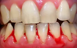 Chảy máu chân răng có nguy hiểm không?