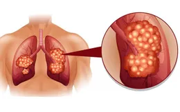 Tầm soát sớm tăng khả năng điều trị ung thư phổi