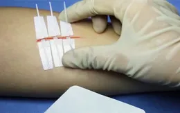 Miếng dán vết thương thay thế những mũi khâu