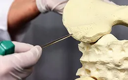 Ung thư xương: Căn bệnh di căn nhanh như cơn lốc