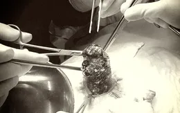 Lấy 1kg tóc trong dạ dày cô bé nghiện ăn tóc