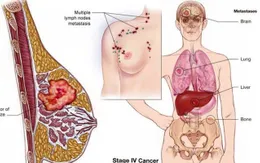 Những điều cần biết về ung thư gan di căn