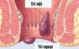 Người bị trĩ nên ăn gì?