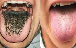 Lông mọc trong lưỡi - Căn bệnh cực hiếm do dùng kháng sinh
