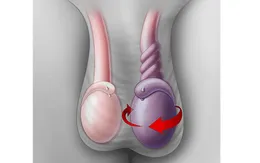 Đừng chủ quan với xoắn tinh hoàn