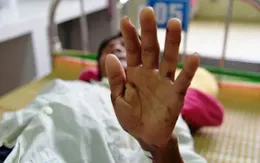 Quảng Ngãi: Thông tin mới về hội chứng viêm da dày sừng bàn tay, bàn chân