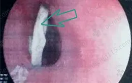 Người đàn ông bị thủng thực quản vì hóc xương gà