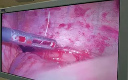 Mở u xơ thực quản lấy xương cá cho nam thanh niên
