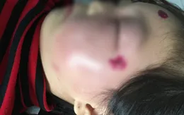 Bé gái 6 tuổi khuôn mặt sưng phù vì nhiễm trùng huyết