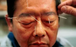 Y học cổ truyền Trung Quốc được áp dụng để điều trị trầm cảm tại Mỹ