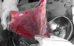 Cứu sống thai nhi có dây rốn bám màng hiếm gặp