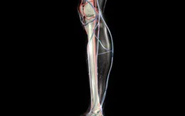 Kỹ thuật mới trong điều trị hẹp động mạch chi dưới