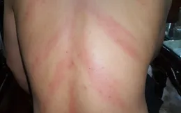 Có nên cạo gió để chữa bệnh