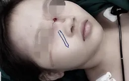 Bé gái 6 tuổi bị bút chì đâm xuyên sống mũi do té ngã