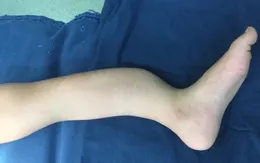 Bị loạn sản xơ xương, bé 8 tuổi cẳng chân biến dạng