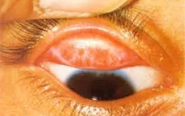 Đau mắt hột có nguy hiểm?