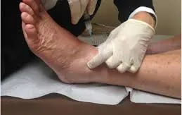 Biến chứng khó lường do lạm dụng tiêm thuốc vào khớp