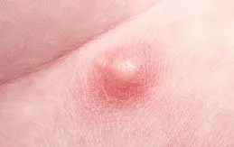 Nổi mụn bất thường ở "vùng kín" - Chị em chớ chủ quan
