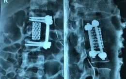 3 ca mổ liên tiếp cứu người đàn ông bị rơi từ độ cao 8m