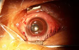 Rùng mình: Gắp cây đinh dài 2,5cm trong... mắt người đàn ông