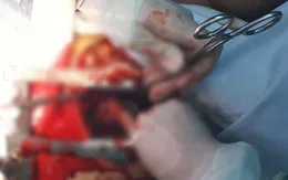 Cứu người đàn ông bị thanh gỗ đập vào lồng ngực gây vỡ tim