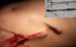 Ngã lúc chơi đùa, bé trai bị cây cỏ voi đâm thủng bụng