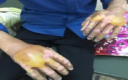 Viêm da tiếp xúc kích ứng do bôi thuốc không đúng chỉ định