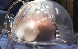 Loại bỏ viêm gan C khỏi phổi hiến tặng