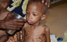 UNICEF: Hơn 30% trẻ em thế giới có vấn đề về dinh dưỡng