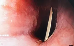 Vừa ăn vừa nói chuyện, người đàn ông bị xương gà đâm xuyên thực quản