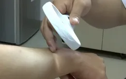 Dày sừng nang lông - Căn bệnh khiến nhiều người khổ sở vào mùa đông