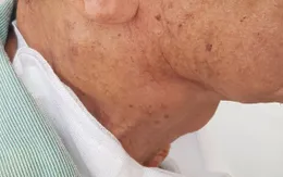 Khó thở, suy kiệt vì ung thư hạ họng vì từ chối chỉ định điều trị
