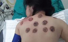 Nguy cơ hoại tử da khi đi giác hơi