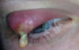 Phân biệt mắt bị chắp - lẹo