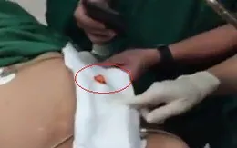 Nắp tuýp thuốc bít tắc phế quản, người đàn ông nguy kịch