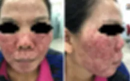 Đẹp hay hại da từ phương pháp lột da?