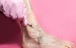 Suy giãn tĩnh mạch - Nỗi lo của những người lớn tuổi