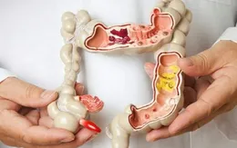 Công nghệ mới phát hiện sớm ung thư đại trực tràng
