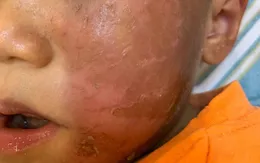 Coi chừng tổn thương da trẻ trong mùa Halloween