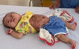 Xót xa bé 5 tháng tuổi bị viêm da tiết bã bội nhiễm nặng