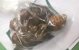 Ngỡ ngàng khối bã thức ăn toàn đồng xu và... hạt xoài