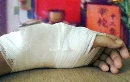 Phải nhập viện chỉnh xương gãy sau 20 ngày "đặt niềm tin" vào thuốc nam