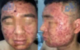 Bùng phát trứng cá do sử dụng thuốc nam không rõ nguồn gốc
