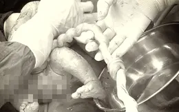 Nút thắt dây rốn - Mối nguy hiểm tiềm ẩn