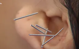 Chữa thừa cân, béo phì bằng Y học cổ truyền