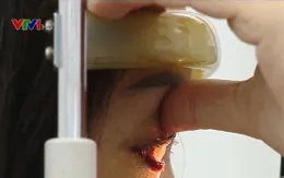Mù mắt do tiêm filler nâng mũi bởi "bác sĩ rởm" tại hàng sửa móng tay, nối mi