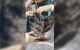 Phổi đen như than của người hút thuốc