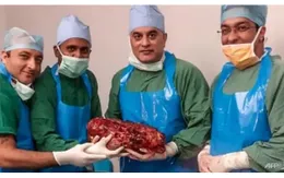 Phẫu thuật cắt bỏ quả thận khổng lồ nặng 7,4 kg của một bệnh nhân Ấn Độ