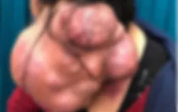 Từ khối u lành, sau 25 năm hóa ác tính nặng 3kg đeo bám trên cổ