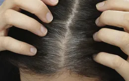 Nhận biết người bệnh tâm thần qua nang tóc